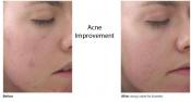 The image shows Lustre Acne Treatment